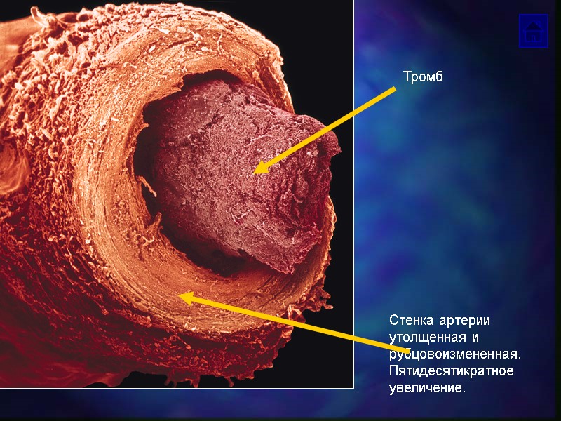 Стенка артерии утолщенная и рубцовоизмененная.  Пятидесятикратное увеличение. Тромб
